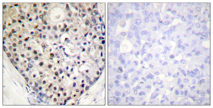 DDIT3 / CHOP Antibody - Immunohistochemistry analysis of paraffin-embedded human breast carcinoma, using CHOP (Phospho-Ser30) Antibody. The picture on the right is blocked with the phospho peptide.