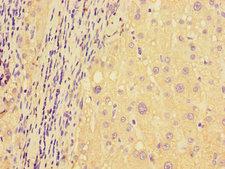 DDIT4 / REDD1 Antibody - Immunohistochemistry of paraffin-embedded human liver cancer tissue using DDIT4L Antibody at dilution of 1:100
