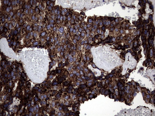 DDOST / OST48 Antibody - IHC of paraffin-embedded Adenocarcinoma of Human breast tissue using anti-DDOST mouse monoclonal antibody. (heat-induced epitope retrieval by 1 mM EDTA in 10mM Tris, pH8.5, 120°C for 3min).