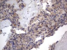 DDOST / OST48 Antibody - IHC of paraffin-embedded Adenocarcinoma of Human breast tissue using anti-DDOST mouse monoclonal antibody. (Heat-induced epitope retrieval by 1 mM EDTA in 10mM Tris, pH8.5, 120°C for 3min).
