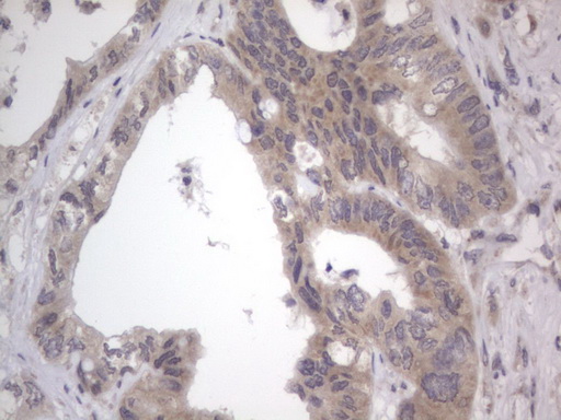 DDOST / OST48 Antibody - IHC of paraffin-embedded Adenocarcinoma of Human colon tissue using anti-DDOST mouse monoclonal antibody. (Heat-induced epitope retrieval by 1 mM EDTA in 10mM Tris, pH8.5, 120°C for 3min).