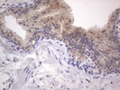 DDOST / OST48 Antibody - IHC of paraffin-embedded Carcinoma of Human prostate tissue using anti-DDOST mouse monoclonal antibody. (Heat-induced epitope retrieval by 1 mM EDTA in 10mM Tris, pH8.5, 120°C for 3min).