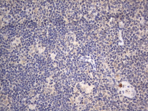 DDOST / OST48 Antibody - IHC of paraffin-embedded Human lymphoma tissue using anti-DDOST mouse monoclonal antibody. (Heat-induced epitope retrieval by 1 mM EDTA in 10mM Tris, pH8.5, 120°C for 3min).