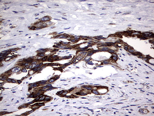 DDOST / OST48 Antibody - IHC of paraffin-embedded Adenocarcinoma of Human colon tissue using anti-DDOST mouse monoclonal antibody. (Heat-induced epitope retrieval by 1 mM EDTA in 10mM Tris, pH9.0, 120°C for 3min).