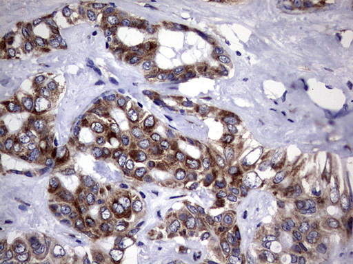 DDOST / OST48 Antibody - IHC of paraffin-embedded Carcinoma of Human liver tissue using anti-DDOST mouse monoclonal antibody. (Heat-induced epitope retrieval by 1 mM EDTA in 10mM Tris, pH9.0, 120°C for 3min).