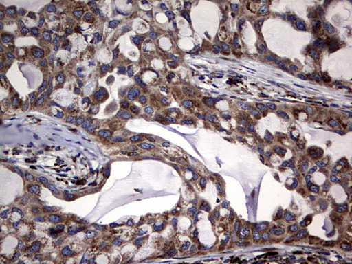 DDOST / OST48 Antibody - IHC of paraffin-embedded Carcinoma of Human lung tissue using anti-DDOST mouse monoclonal antibody. (Heat-induced epitope retrieval by 1 mM EDTA in 10mM Tris, pH9.0, 120°C for 3min).