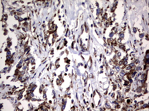 DDOST / OST48 Antibody - IHC of paraffin-embedded Adenocarcinoma of Human ovary tissue using anti-DDOST mouse monoclonal antibody. (Heat-induced epitope retrieval by 1 mM EDTA in 10mM Tris, pH9.0, 120°C for 3min).