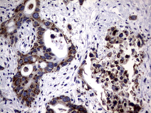 DDOST / OST48 Antibody - IHC of paraffin-embedded Carcinoma of Human pancreas tissue using anti-DDOST mouse monoclonal antibody. (Heat-induced epitope retrieval by 1 mM EDTA in 10mM Tris, pH9.0, 120°C for 3min).