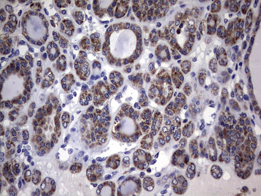 DDOST / OST48 Antibody - IHC of paraffin-embedded Carcinoma of Human thyroid tissue using anti-DDOST mouse monoclonal antibody. (Heat-induced epitope retrieval by 1 mM EDTA in 10mM Tris, pH9.0, 120°C for 3min).