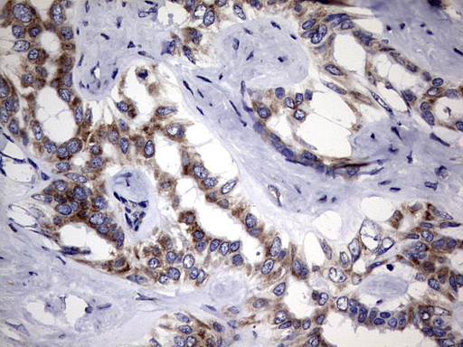 DDOST / OST48 Antibody - IHC of paraffin-embedded Carcinoma of Human liver tissue using anti-DDOST mouse monoclonal antibody. (Heat-induced epitope retrieval by 1 mM EDTA in 10mM Tris, pH9.0, 120°C for 3min).