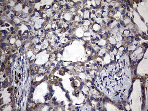 DDOST / OST48 Antibody - IHC of paraffin-embedded Carcinoma of Human lung tissue using anti-DDOST mouse monoclonal antibody. (Heat-induced epitope retrieval by 1 mM EDTA in 10mM Tris, pH9.0, 120°C for 3min).