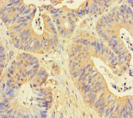 DDOST / OST48 Antibody - Immunohistochemistry of paraffin-embedded human colon cancer using RPN1 Antibody at dilution of 1:100