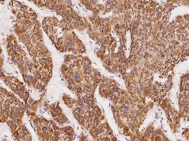 DDOST / OST48 Antibody - Immunochemical staining of human DDOST in human hepatoma with rabbit polyclonal antibody at 1:1000 dilution, formalin-fixed paraffin embedded sections.