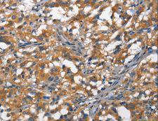 DDR2 Antibody - Immunohistochemistry of paraffin-embedded Human thyroid cancer using DDR2 Polyclonal Antibody at dilution of 1:40.