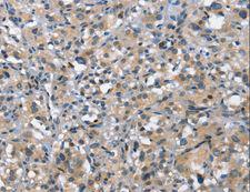 DDR2 Antibody - Immunohistochemistry of paraffin-embedded Human thyroid cancer using DDR2 Polyclonal Antibody at dilution of 1:40.