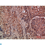 DDR2 Antibody - Immunohistochemical analysis of paraffin-embedded human-lung-cancer, antibody was diluted at 1:200.