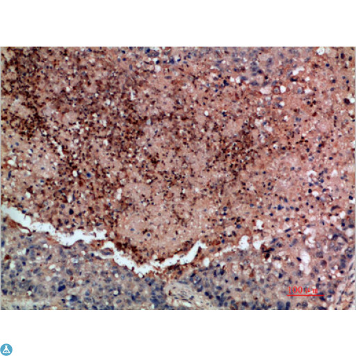 DDR2 Antibody - Immunohistochemical analysis of paraffin-embedded human-lung-cancer, antibody was diluted at 1:200.