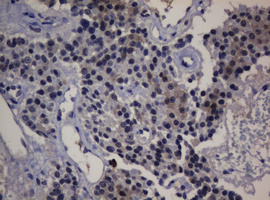 DDT / Dopamine Tautomerase Antibody - IHC of paraffin-embedded Carcinoma of Human pancreas tissue using anti-DDT mouse monoclonal antibody.