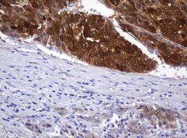 DDT / Dopamine Tautomerase Antibody - IHC of paraffin-embedded Carcinoma of Human liver tissue using anti-DDT mouse monoclonal antibody.