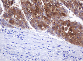 DDT / Dopamine Tautomerase Antibody - IHC of paraffin-embedded Carcinoma of Human liver tissue using anti-DDT mouse monoclonal antibody.