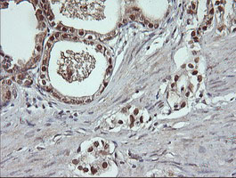 DDT / Dopamine Tautomerase Antibody - IHC of paraffin-embedded Carcinoma of Human prostate tissue using anti-DDT mouse monoclonal antibody.