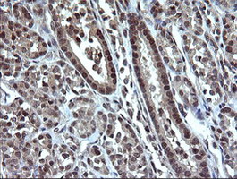 DDT / Dopamine Tautomerase Antibody - IHC of paraffin-embedded Carcinoma of Human thyroid tissue using anti-DDT mouse monoclonal antibody.