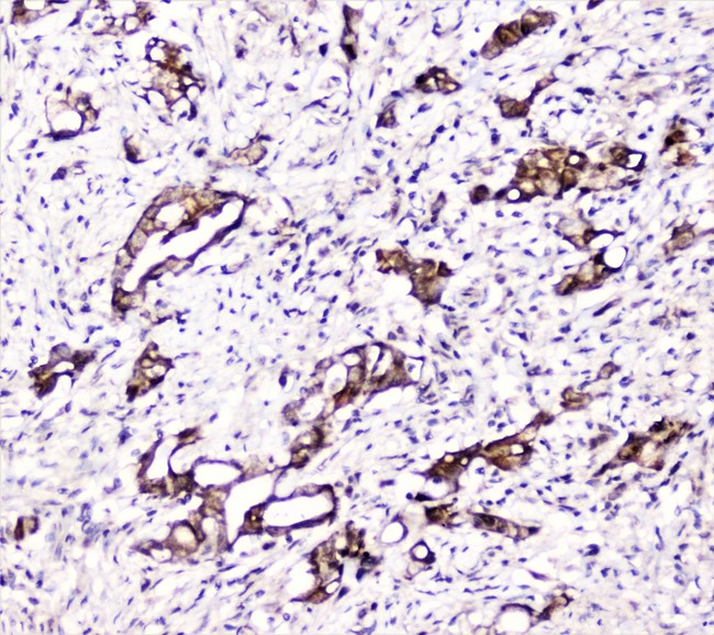 DDT / Dopamine Tautomerase Antibody - IHC analysis of DDT using anti-DDT antibody. DDT was detected in paraffin-embedded section of human intestinal cancer tissue. Heat mediated antigen retrieval was performed in citrate buffer (pH6, epitope retrieval solution) for 20 mins. The tissue section was blocked with 10% goat serum. The tissue section was then incubated with 2µg/ml rabbit anti-DDT Antibody overnight at 4°C. Biotinylated goat anti-rabbit IgG was used as secondary antibody and incubated for 30 minutes at 37°C. The tissue section was developed using Strepavidin-Biotin-Complex (SABC) with DAB as the chromogen.