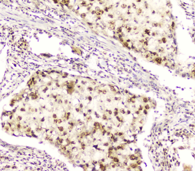 DDT / Dopamine Tautomerase Antibody - IHC analysis of DDT using anti-DDT antibody. DDT was detected in paraffin-embedded section of human lung cancer tissue. Heat mediated antigen retrieval was performed in citrate buffer (pH6, epitope retrieval solution) for 20 mins. The tissue section was blocked with 10% goat serum. The tissue section was then incubated with 2µg/ml rabbit anti-DDT Antibody overnight at 4°C. Biotinylated goat anti-rabbit IgG was used as secondary antibody and incubated for 30 minutes at 37°C. The tissue section was developed using Strepavidin-Biotin-Complex (SABC) with DAB as the chromogen.