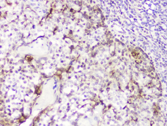DDT / Dopamine Tautomerase Antibody - IHC analysis of DDT using anti-DDT antibody. DDT was detected in paraffin-embedded section of human tonsil tissue. Heat mediated antigen retrieval was performed in citrate buffer (pH6, epitope retrieval solution) for 20 mins. The tissue section was blocked with 10% goat serum. The tissue section was then incubated with 2µg/ml rabbit anti-DDT Antibody overnight at 4°C. Biotinylated goat anti-rabbit IgG was used as secondary antibody and incubated for 30 minutes at 37°C. The tissue section was developed using Strepavidin-Biotin-Complex (SABC) with DAB as the chromogen.