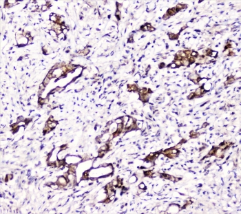 DDT / Dopamine Tautomerase Antibody - IHC staining of FFPE human intestinal cancer with DDT antibody at 2ug/ml. HIER: boil tissue sections in pH6, 10mM citrate buffer, for 10-20 min followed by cooling at RT for 20 min.