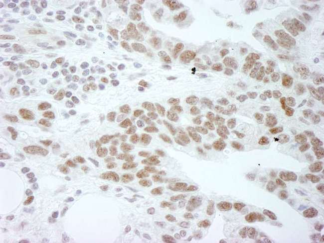 DDX1 Antibody - Detection of Human DDX1 by Immunohistochemistry. Sample: FFPE section of human ovarian tumor. Antibody: Affinity purified rabbit anti-DDX1 used at a dilution of 1:250.