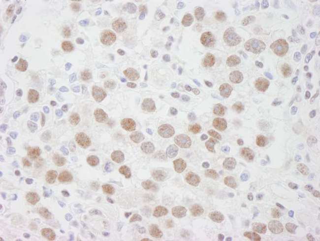 DDX1 Antibody - Detection of Human DDX1 by Immunohistochemistry. Sample: FFPE section of human seminoma. Antibody: Affinity purified rabbit anti-DDX1 used at a dilution of 1:250.