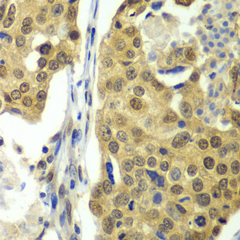 DDX1 Antibody - Immunohistochemistry of paraffin-embedded human lung cancer tissue.