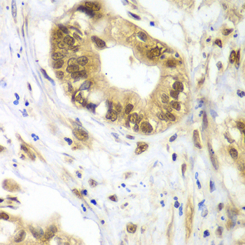 DDX1 Antibody - Immunohistochemistry of paraffin-embedded human liver cancer tissue.