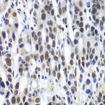 DDX1 Antibody - Immunohistochemistry of paraffin-embedded human colon carcinoma tissue.