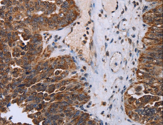 DDX11 / CHLR1 Antibody - Immunohistochemistry of paraffin-embedded Human breast cancer using DDX11 Polyclonal Antibody at dilution of 1:30.