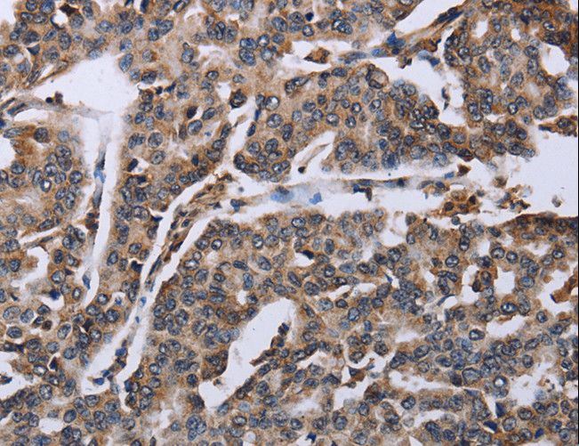 DDX11 / CHLR1 Antibody - Immunohistochemistry of paraffin-embedded Human breast cancer using DDX11 Polyclonal Antibody at dilution of 1:30.