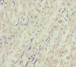 DDX11 / CHLR1 Antibody - Immunohistochemistry of paraffin-embedded human gastric cancer at dilution 1:100