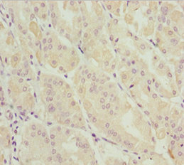 DDX11 / CHLR1 Antibody - Immunohistochemistry of paraffin-embedded human gastric cancer at dilution 1:100