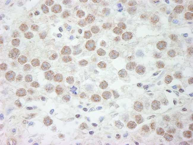 DDX17 Antibody - Detection of Human DDX17 by Immunohistochemistry. Sample: FFPE section of human seminoma. Antibody: Affinity purified rabbit anti-DDX17 used at a dilution of 1:500.