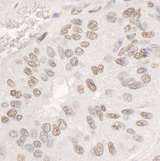 DDX17 Antibody - Detection of Human DDX17 by Immunohistochemistry. Sample: FFPE section of human ovarian carcinoma. Antibody: Affinity purified rabbit anti-DDX17 used at a dilution of 1:1000 (1 ug/ml). Detection: DAB.