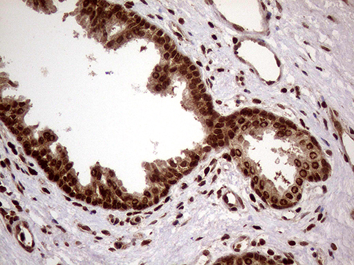 DDX19A Antibody - Immunohistochemical staining of paraffin-embedded Carcinoma of Human prostate tissue using anti-DDX19A mouse monoclonal antibody. (Heat-induced epitope retrieval by 1mM EDTA in 10mM Tris buffer. (pH8.5) at 120°C for 3 min. (1:500)