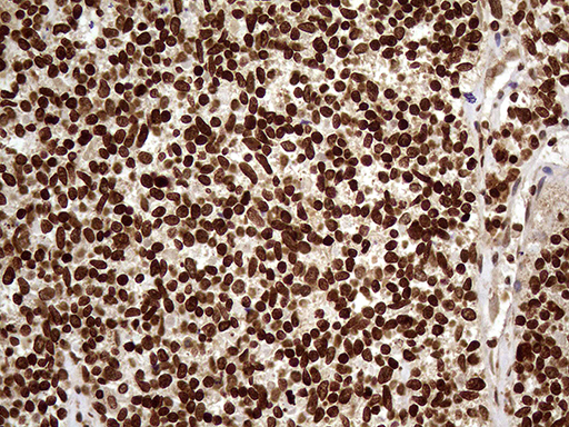 DDX19A Antibody - Immunohistochemical staining of paraffin-embedded Carcinoma of Human kidney tissue using anti-DDX19A mouse monoclonal antibody. (Heat-induced epitope retrieval by 1mM EDTA in 10mM Tris buffer. (pH8.5) at 120°C for 3 min. (1:500)