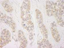 DDX19B Antibody - Detection of Human DDX19 by Immunohistochemistry. Sample: FFPE section of human breast carcinoma. Antibody: Affinity purified rabbit anti-DDX19 used at a dilution of 1:250. Epitope Retrieval Buffer-High pH (IHC-101J) was substituted for Epitope Retrieval Buffer-Reduced pH.