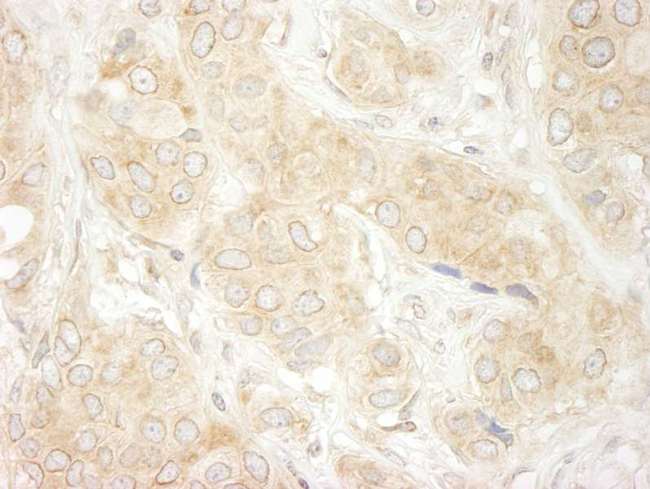 DDX19B Antibody - Detection of Human DDX19 by Immunohistochemistry. Sample: FFPE section of human breast carcinoma. Antibody: Affinity purified rabbit anti-DDX19 used at a dilution of 1:200 (1 ug/ml). Detection: DAB.