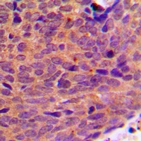 DDX19B Antibody - Immunohistochemical analysis of DDX19B staining in human breast cancer formalin fixed paraffin embedded tissue section. The section was pre-treated using heat mediated antigen retrieval with sodium citrate buffer (pH 6.0). The section was then incubated with the antibody at room temperature and detected with HRP and DAB as chromogen. The section was then counterstained with hematoxylin and mounted with DPX.