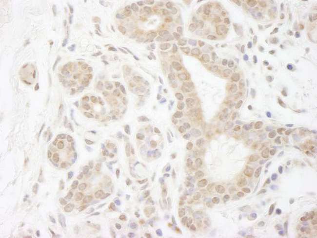 DDX20 / GEMIN3 Antibody - Detection of Human DDX20 by Immunohistochemistry. Sample: FFPE section of human breast carcinoma. Antibody: Affinity purified rabbit anti-DDX20 used at a dilution of 1:250.