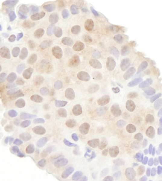 DDX20 / GEMIN3 Antibody - Detection of Human DDX20 by Immunohistochemistry. Sample: FFPE section of human breast carcinoma. Antibody: Affinity purified rabbit anti-DDX20 used at a dilution of 1:200 (1 ug/ml). Detection: DAB.