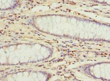 DDX20 / GEMIN3 Antibody - Immunohistochemistry of paraffin-embedded human colon cancer at dilution 1:100