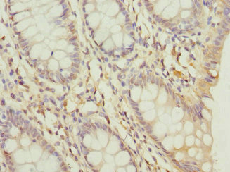 DDX20 / GEMIN3 Antibody - Immunohistochemistry of paraffin-embedded human colon cancer at dilution 1:100